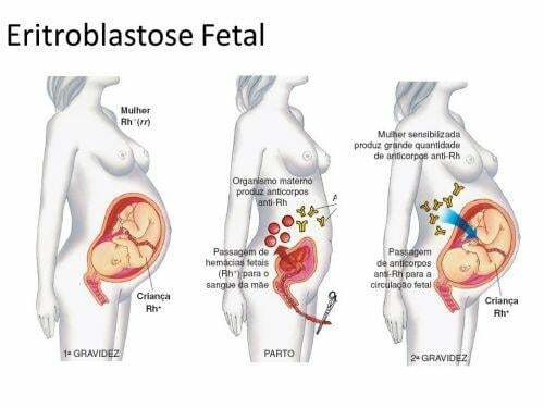 Erythroblastosis fetalis eller hæmolytisk sygdom hos den nyfødte